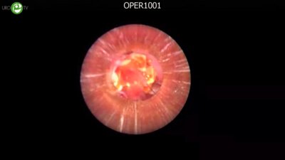 Артемов А.В. - Ретроградная интраренальная хирургия; Меринов Д.C. - Миниперкутанная нефролитолапаксия