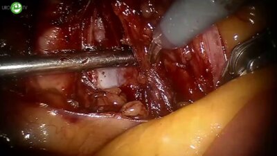 Шпоть Е.В. - Робот-ассистированная цистэктомия с интракоральным формированием резервуара