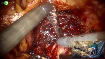 Мосоян М.С. - Робот-ассистированная радикальная простатэктомия с невросбережением