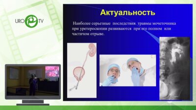 Биктимиров Р. Г. - Экстренная кишечная пластика мочеточника при его травме