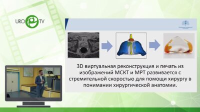Слусаренко Р.И. - 3Д простаты для предоперационного планирования Робот-РПЭ. Миф или реальность