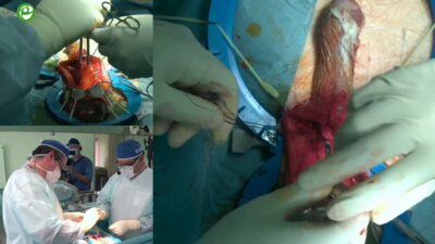 Топузов Т.М. - Имплантация трехкомпонентного фаллопротеза