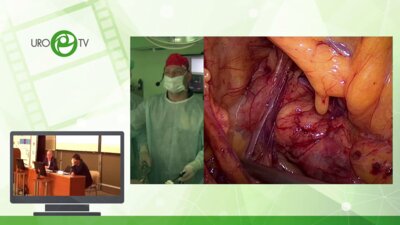 Новиков А.Б. - Лапароскопическая пластика ЛМС