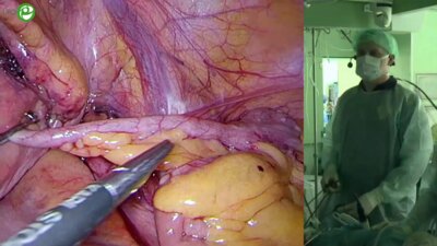 Санжаров А.Е. - Уретероцистоанастомоз при стриктуре мочеточника