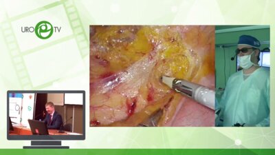 Орлов И.Н. - Лапароскопическая операция при онкологии