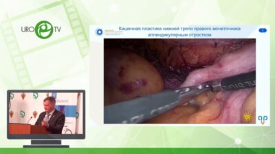 Санжаров А.Е. - Лапароскопическая реконструктивно-пластическая хирургия - урологические возможности тонкой кишки