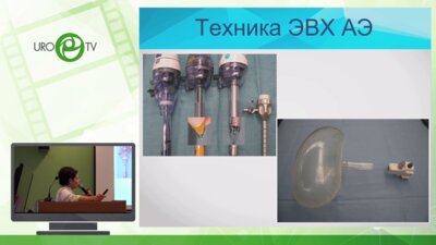 Сушина И.В. - Лапароскопическая энуклеация доброкачественной гиперплазии предстательной железы