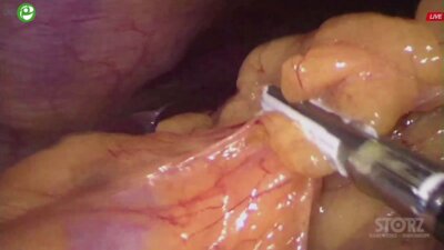 Ефанов, Казаков - Лапароскопическая гастрэктомия с лимфодиссекцией D2