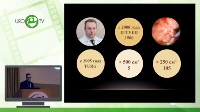 Кнутов А.В. - Лапароскопическая аденомэктомия в клинике профессора Ф.А. Севрюкова