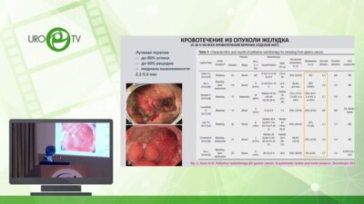 Хоробрых Т.В. - Эндовидеохирургическое лечение осложненных форм распространенного рака желудка