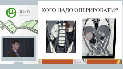 Акрамов Н.Р. - Критерии определения показаний к оперативному лечению простых бессимптомных кист почек у детей