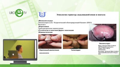 Гринь Е.А. - Стриктура ладьевидной ямки – обзор хирургических способов коррекции
