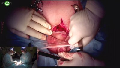 Гулько А.М. - Лигаментотомия полового члена