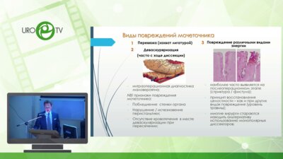 Шпоть Е.В. - Варианты пластических операций при стриктуре мочеточника