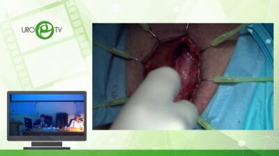 Анастомотическая пластика луковичного отдела уретры. Анастомотическая увеличивающая пластика луковичного отдела уретры