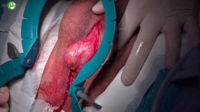 Анастомотическая пластика луковичного отдела уретры. Буккальная пластика головчатого отдела уретры