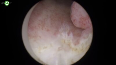 Тулиевая лазерная энуклеация гиперплазии простаты. РИРХ. Лазерная en-bloc резекция стенки мочевого пузыря с опухолью