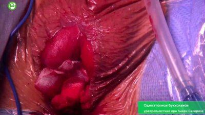 Одноэтапная буккальная уретропластика при Лихен Склерозе