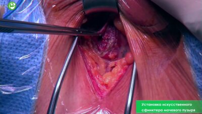 Установка искусственного сфинктера мочевого пузыря