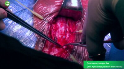 Пластика уретры Квк (или Аугментационный анастомоз)