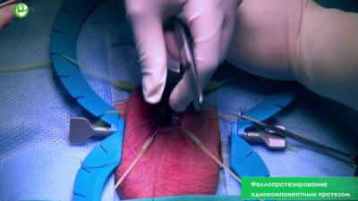 Фаллопротезирование однокомпонентным протезом