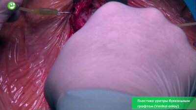 Пластика уретры буккальным графтом (Ventral onlay)