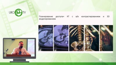 Емельяненко А.В. - Перкутанные вмешательства при МКБ. Этапы, возможные осложнения и борьба с ними