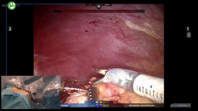 Мосоян М.С. - Робот-ассистированная резекция почки