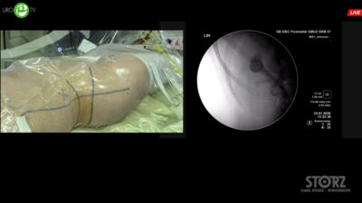 Мартов А.Г. - Мини-перкутанная лазерная нефролитотрипсия