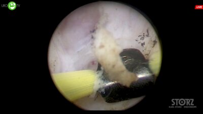 Сорокин Н.И. - Биполярная энуклеация простаты