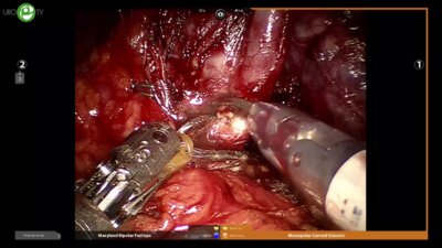 Пушкарь Д.Ю. - Робот – ассистированная нервосберегающая простатэктомия. Попов С.В. - Лапароскпическая монопортовая простатэктомия