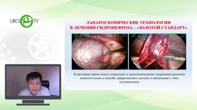 Акрамов Н.Р. - Бездренажная пиелопластика при гидронефрозе у детей раннего возраста - миф и реальность