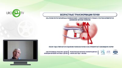 Сизонов В.В.  - Вазоуретеральный конфликт - особенности диагностики и лечения у детей