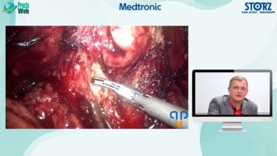 Санжаров А.Е. - Особенности лап. простатэктомии при нестандартной анатомии