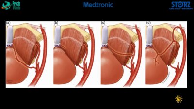 Кочкин А.Д. - Хирургическая анатомия простаты