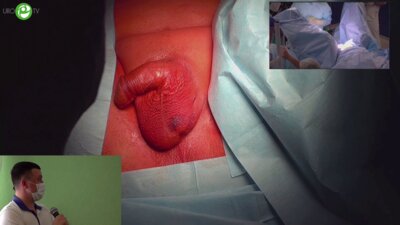 Орлов И.Н. - Установка искусственного сфинктера мочевого пузыря AMS 800