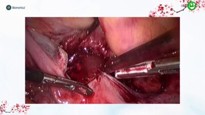 Галлямов Э.А. - Лапароскопическая сакровагинопексия с сохранением матки