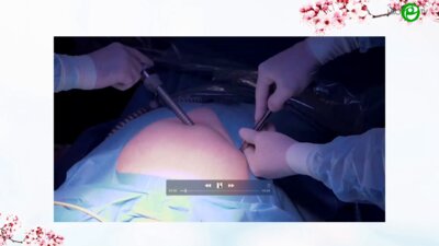 Попов А.А. - Роботическая сакровагинопексия. Москва, операционная МОНИИАГ