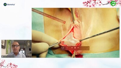 Попов А.А. - Влагалищная пластика пролапса синтетическим имплантом OPUR