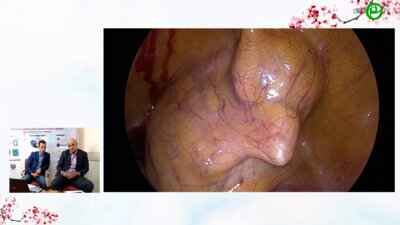 Шкодкин С.В. - Лапароскопическая кольпосуспензия по Burch