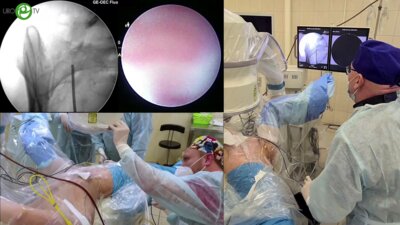 Мартов А.Г. - Представление пациента. Операция «РИРС + ПНЛ»