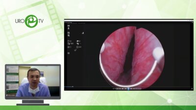 Сорокин Н.И. - Представление пациента. Операция «Плазмокинетическая ТУР ДГПЖ»