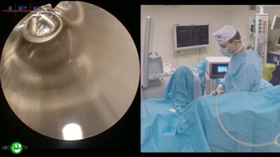 Сорокин Н.И. - En bloc резекция опухоли стенки мочевого пузыря с последующей инцизией предстательной железы