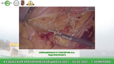 Галлямов Э.А. - Практический курс компании KARL STORZ. Операция: Лапароскопическая радикальная цистэктомия с формированием интракорпорального кишечного кондуита