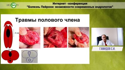 Гамидов С.И. - Оперативные методы лечения болезни Пейрони