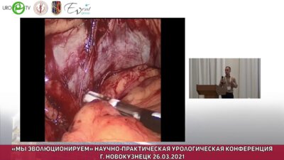 Дианов М.П. - Лапароскопическая лимфодиссекция при раке почки