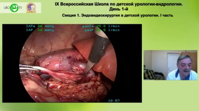 Бондаренко С.Г. - Лапароскопическая пиелопластика ротационным лоскутом. Показания и техника операции