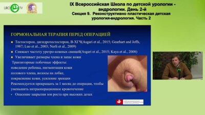 Демин Н.В. - Лечение проксимальных форм гипоспадии трансплантатом слизистой щеки