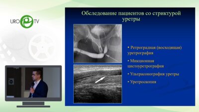 Байков Н.А. - Отдаленные результаты эндоскопического лечения стриктур уретры у мужчин