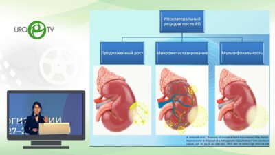 Гаас М.Я. - Маркеры местного рецидива рака почки. Каковы практические перспективы